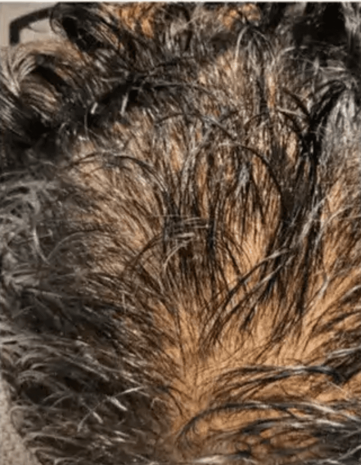 Crown at baseline: scalp visible through thinning coverage