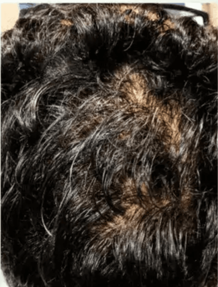 Crown at month six: coverage filled in, far less scalp showing