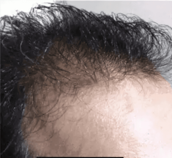 Hairline at baseline: recession and sparse temples