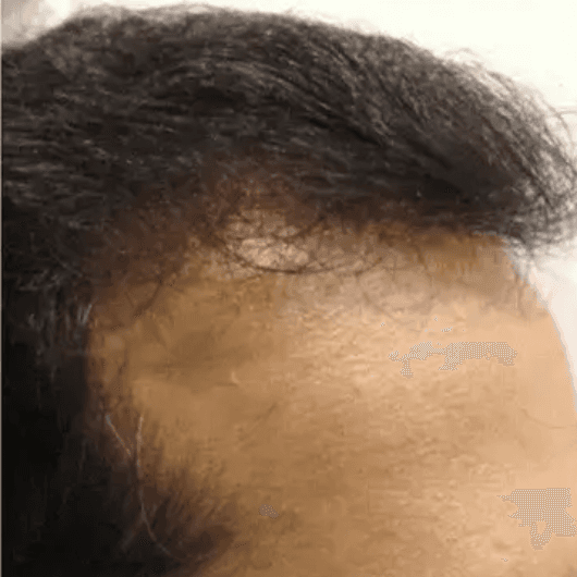 Hairline at month six: denser regrowth along the front line